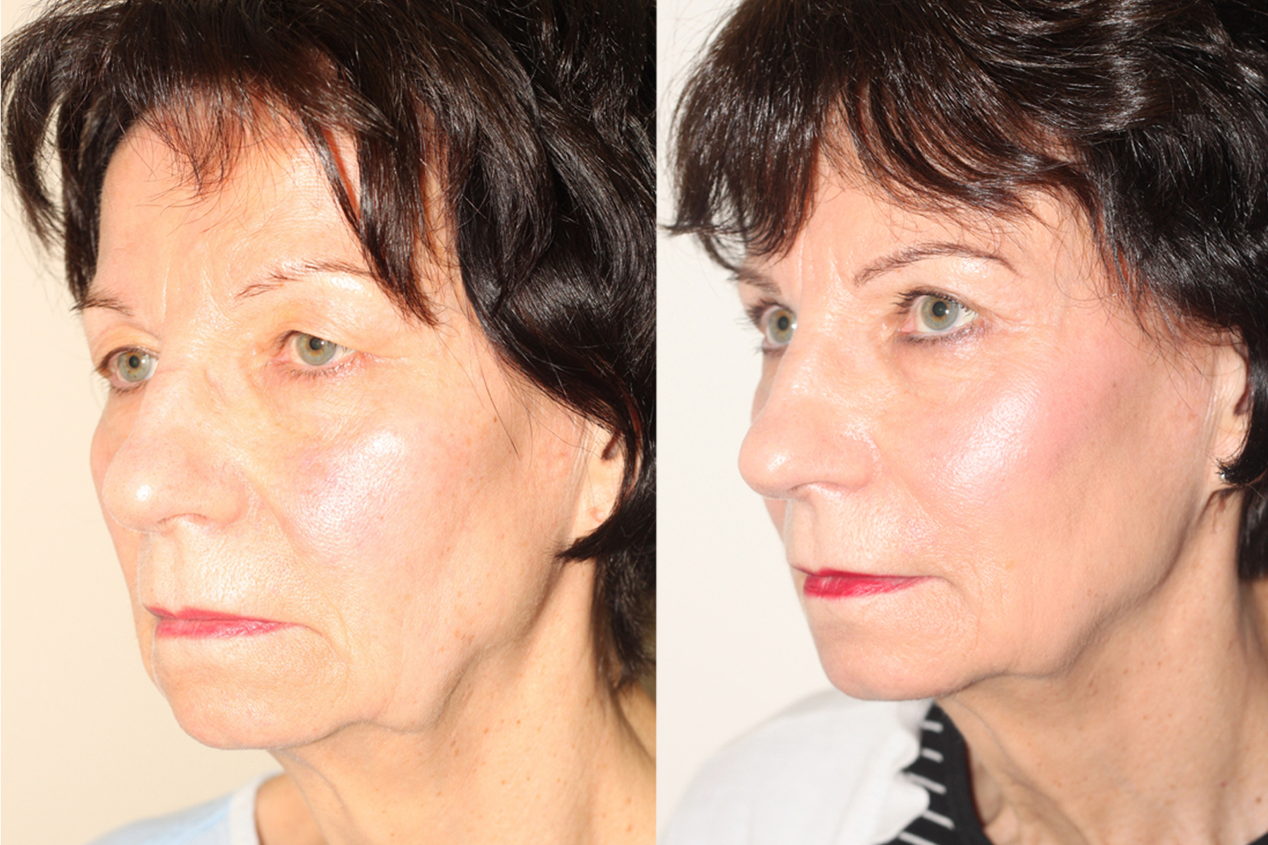 Before and After image of a female who has undergone Upper Blepharoplasty.