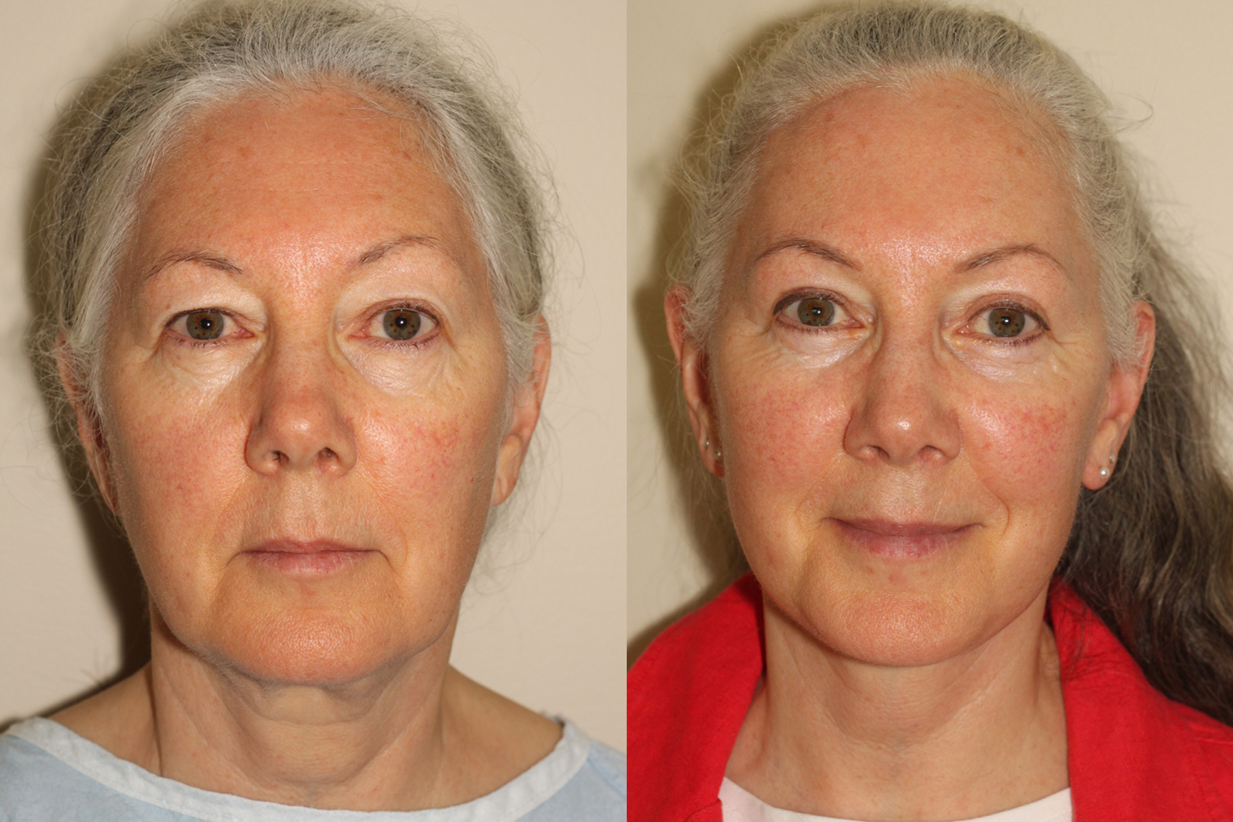 Before and after images of a female who has undergone a facelift, upper blepharoplasty and right sided browlift.