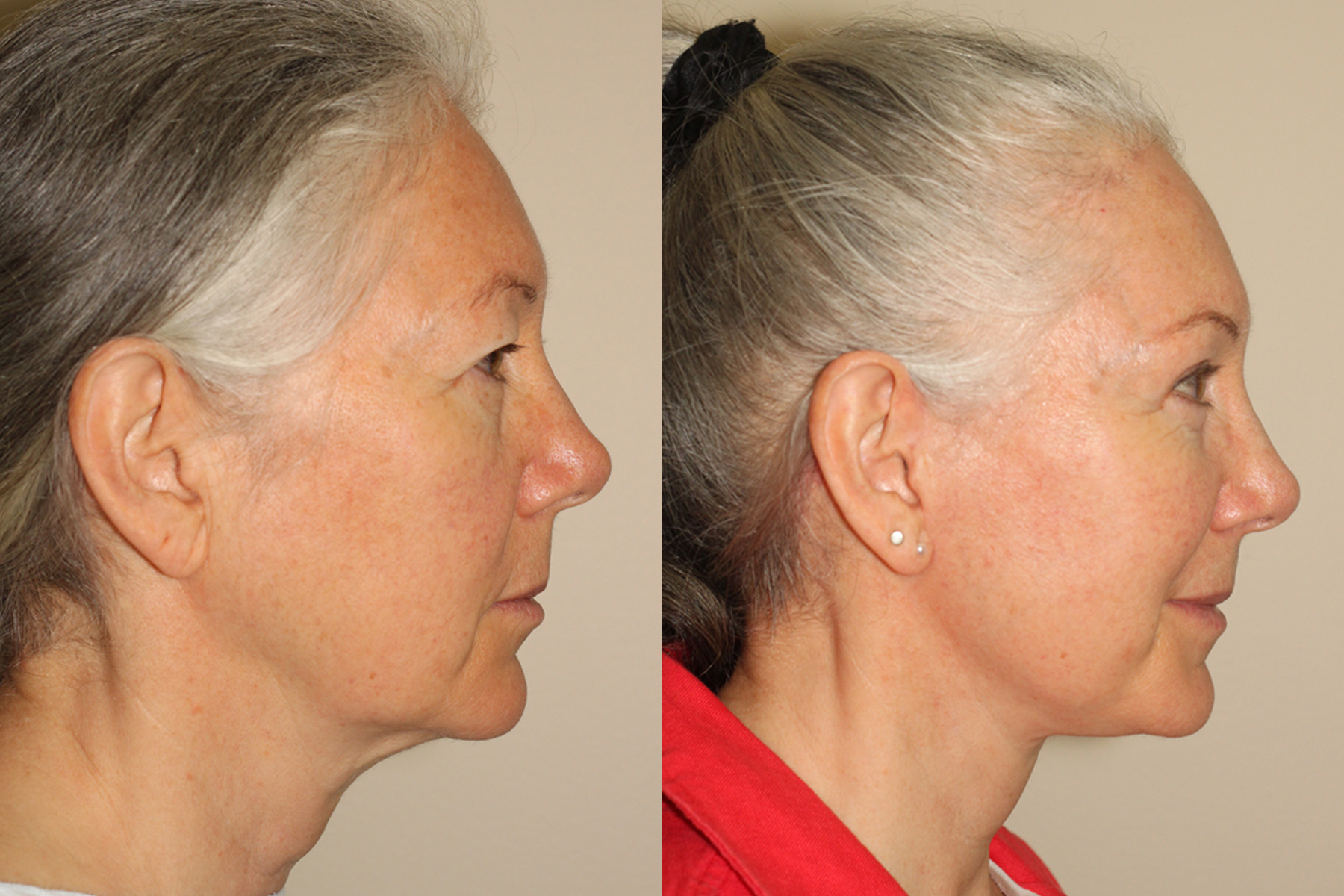 Before and after images of a female who has undergone a facelift, upper blepharoplasty and right sided browlift.