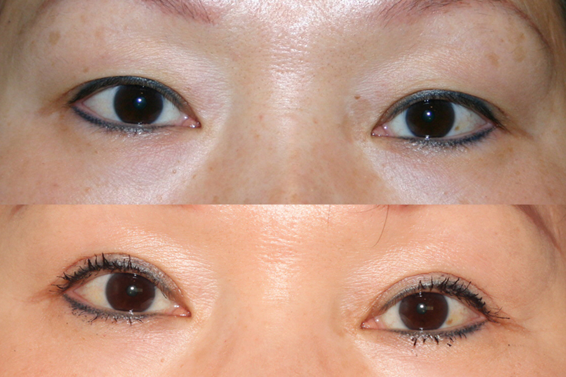 Before and after image of Asian plastic surgery on a young female who has undergone Asian eyelid surgery to create a more defined eyelid crease.