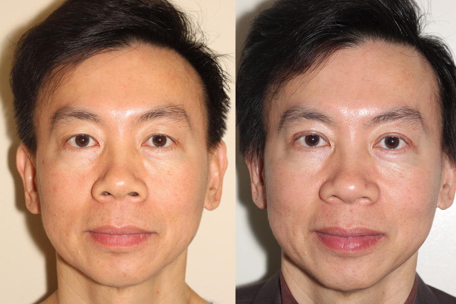 Asian Eyelid Surgery Before And After 72