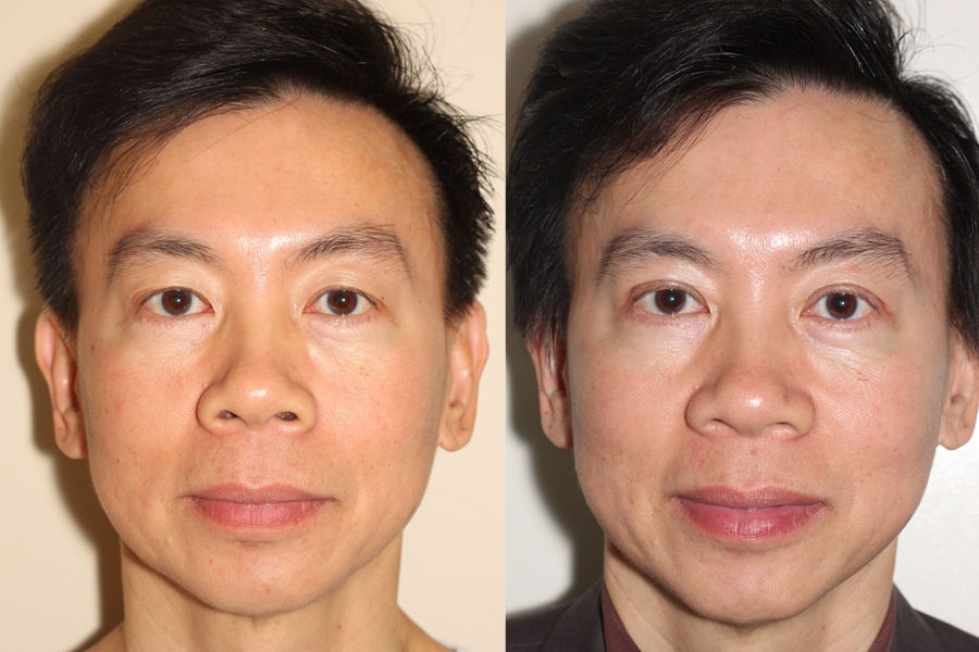 double eyelid surgery before and after