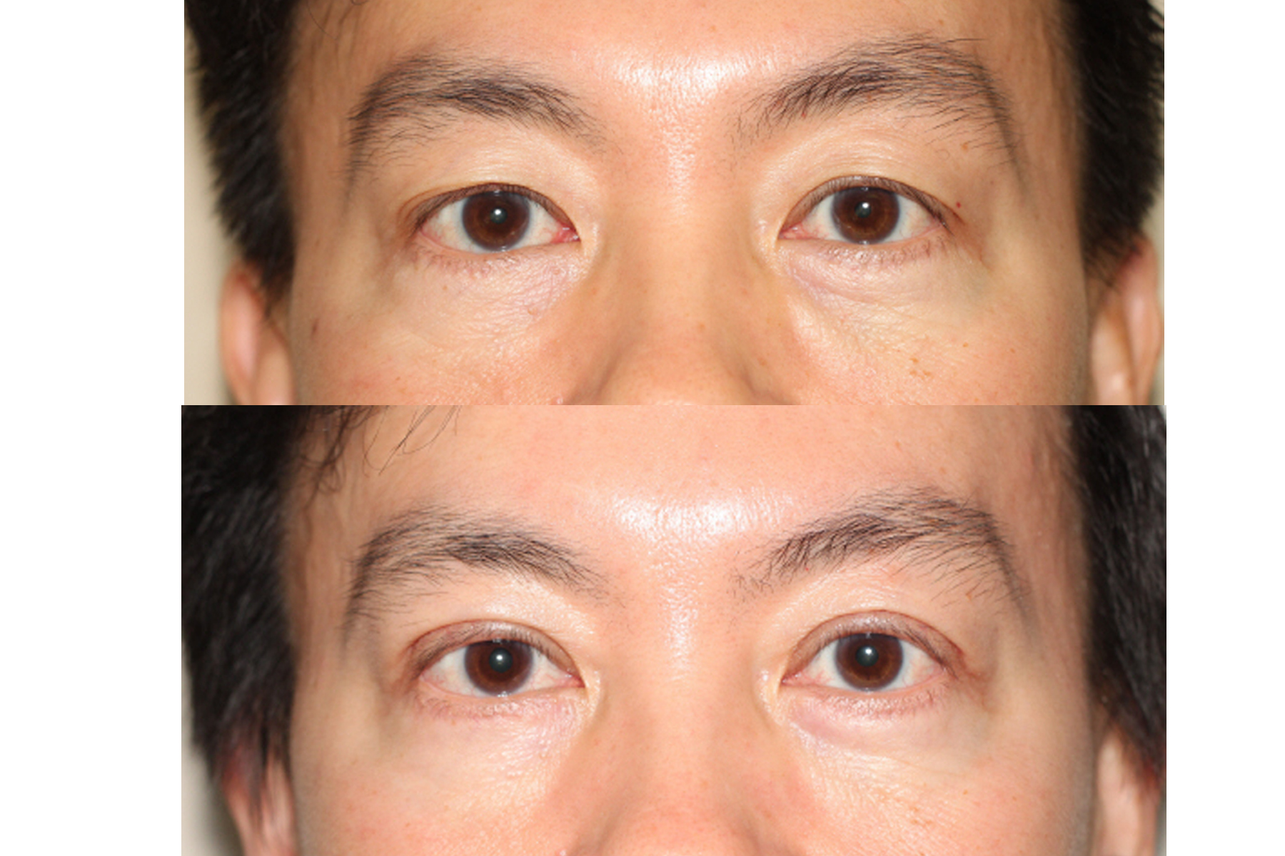 blepharoplasty before and after asian