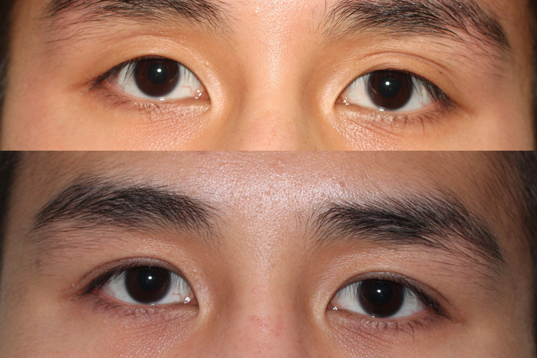 after double eyelid surgery