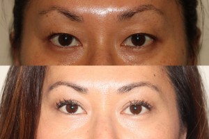 Before and after images of Asian plastic surgery on a female who has undergone double eyelid surgery.