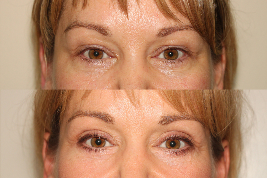 Before and After image of a female who has undergone Upper and Lower Eyelid Lift facial plastic surgery.