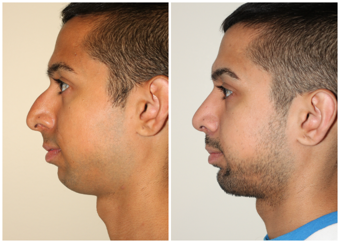rhinoplasty with balancing chin augmentation
