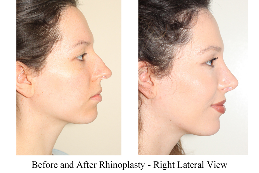Before & After Tip Refinement & Deprojection of the nose - Front View 