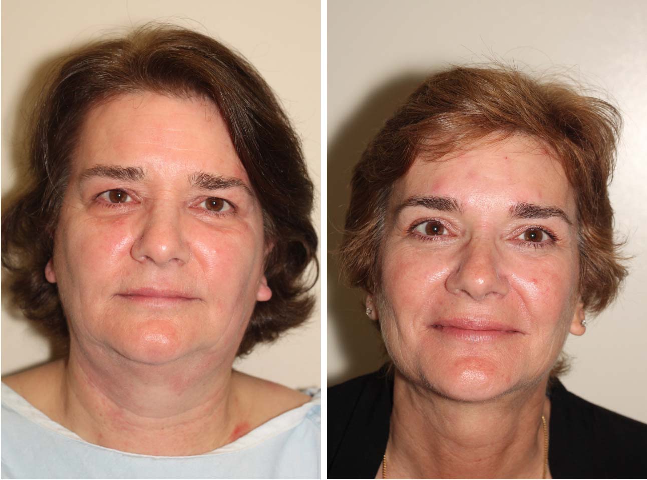 Before and After image of middle-aged female who has undergone Upper Eyelid, Browlift and Facelift.