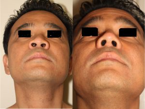 Before and after images of Asian plastic surgery on a male who has undergone an Alar Base Narrowing Open Rhinoplasty.