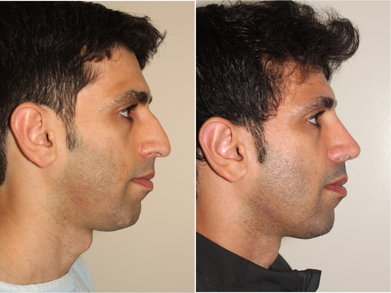 Male Plastic Surgery NYC  Facial Procedures For Men