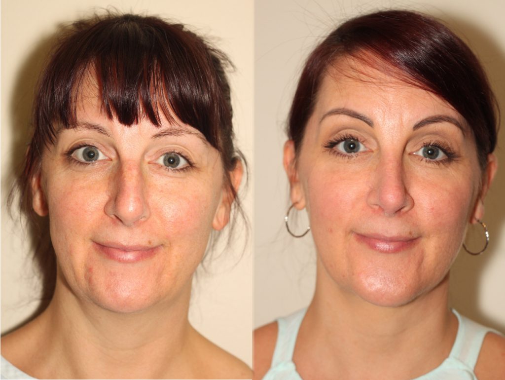 Before and After Chin Augmentation and Neck Liposuction*
