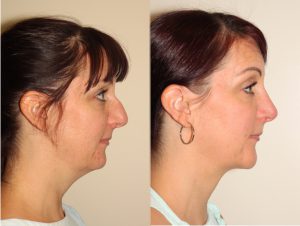 Before and after images of a young female who has undergone chin implant surgery and neck liposuction.