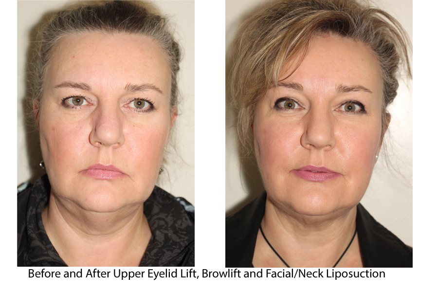 Before and After Upper Eyelid Lift, Browlift and Face/Neck Liposuction