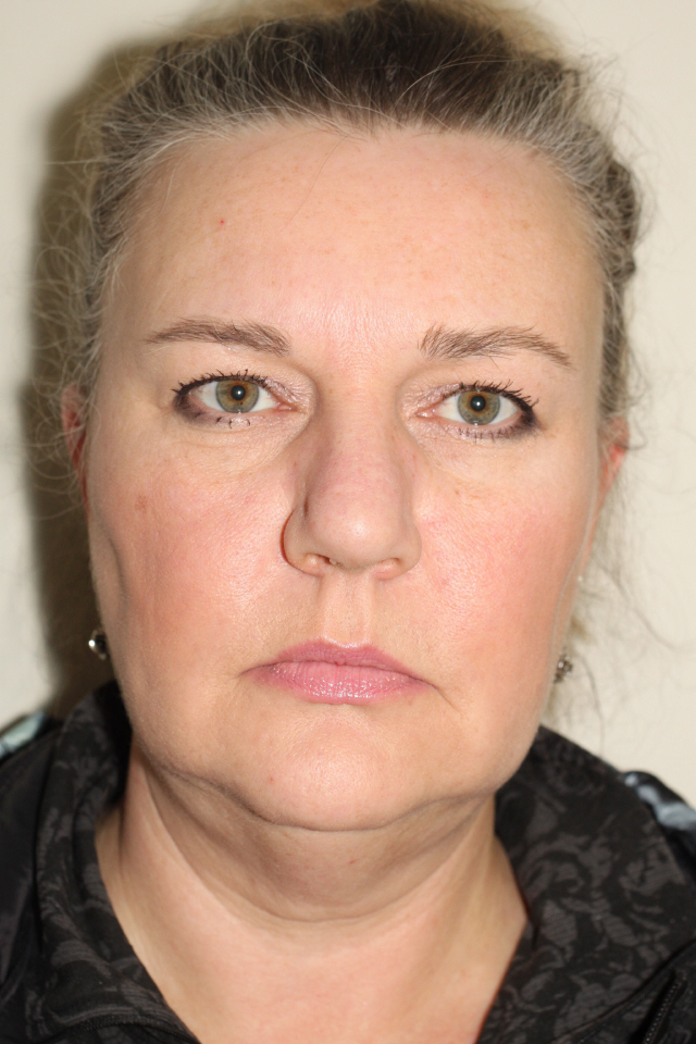 Before Upper Eyelid Lift, Browlift and Face/Neck Liposuction