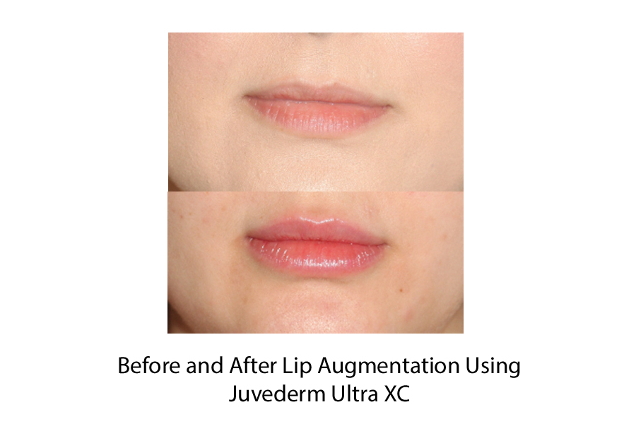 Before and After Lip Augmentation