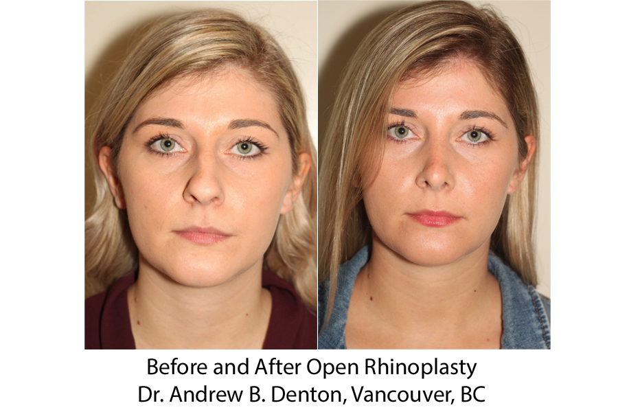 Before and After Open Rhinoplasty Surgery - Front View