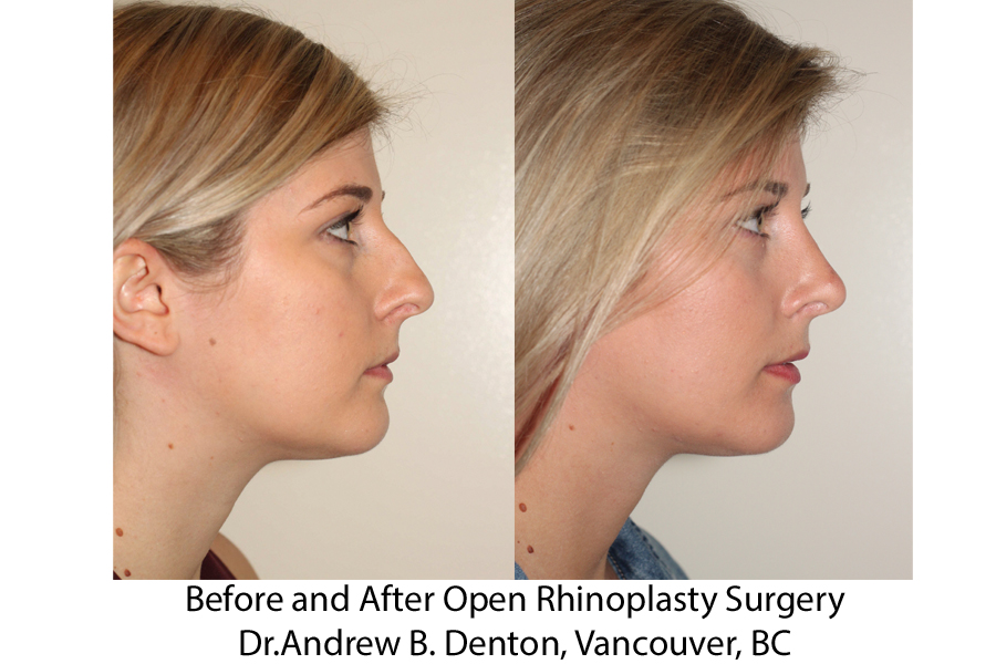 Before and After Open Rhinoplasty - Right Lateral View - Dr. Denton Before  and After Open Rhinoplasty - Right Lateral View 