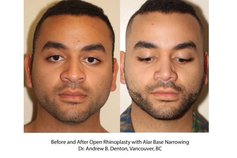 Before And After Open Rhinoplasty With Alar Base Narrowing - Dr. Andrew ...