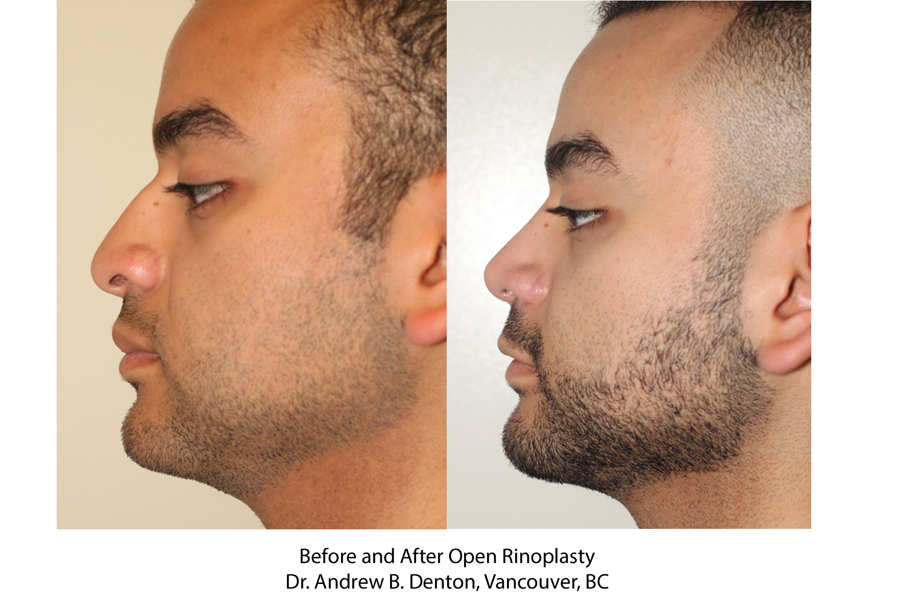 Before and After Open Rhinoplasty - Dr. Andrew B. Denton, Vancouver, BC