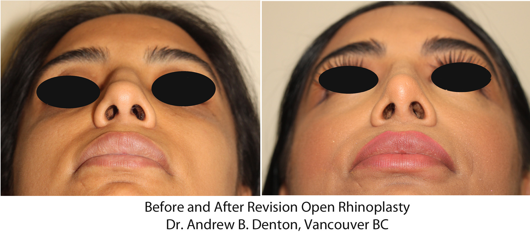 Revision Rhinoplasty