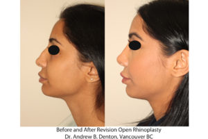 Revision Rhinoplasty before and after photos of a young woman