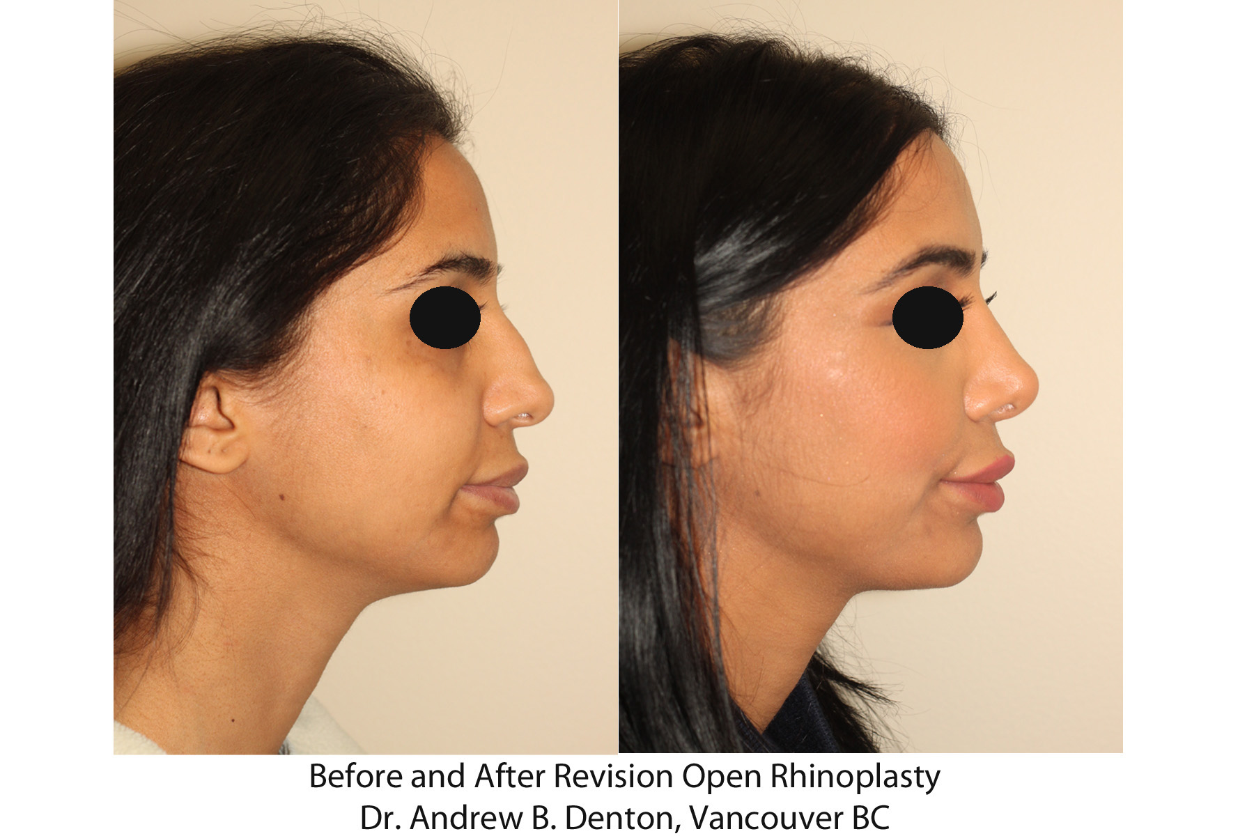 Revision Rhinoplasty