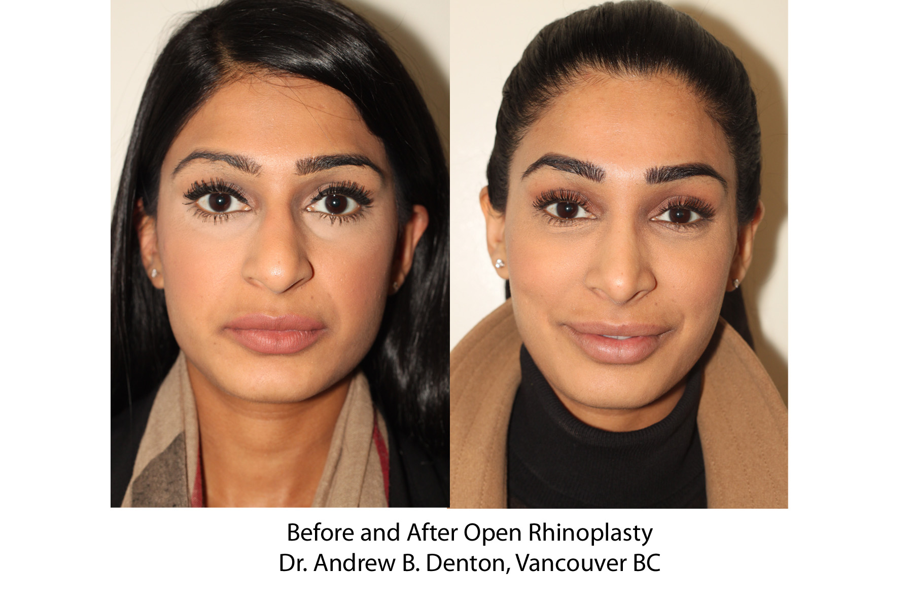 Before and After Open Rhinoplasty - Dr. Andrew B. Denton