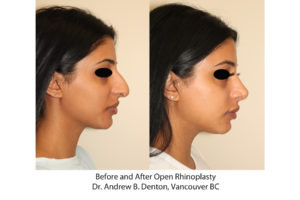 Before and After Open Rhinoplasty - Dr. Andrew B. Denton, Vancouver, BC