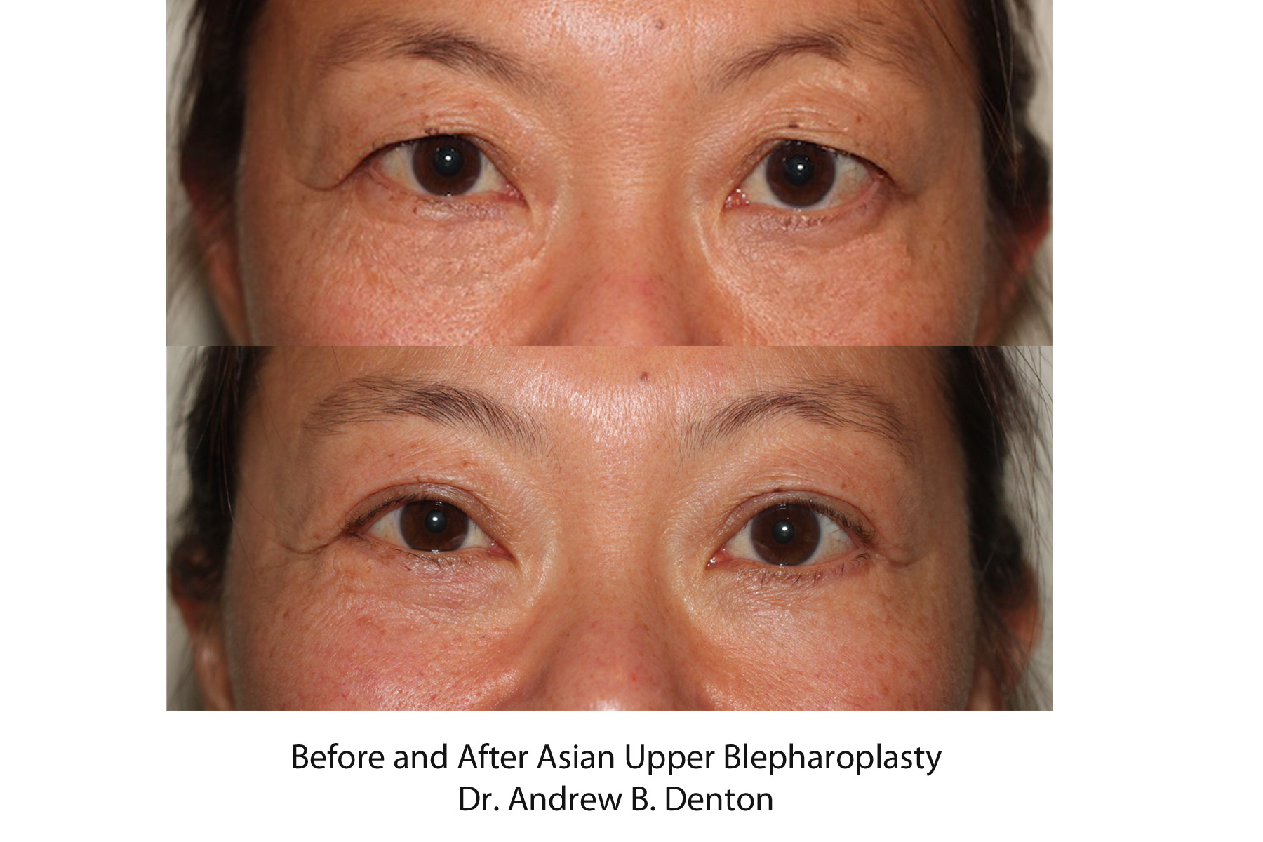 Before and after image of Asian plastic surgery on a female who has undergone Upper Eyelid Lift cosmetic plastic surgery.