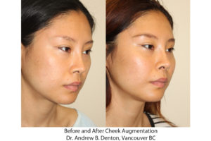 Before and after images of a young Asian female who has undergone cheek implant surgery.