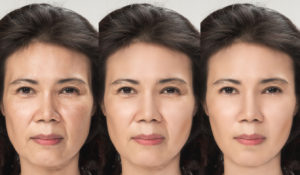 Surgical Facelift Before & After