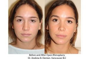 Before and After Rhinoplasty