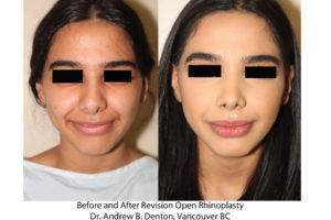 Revision Rhinoplasty