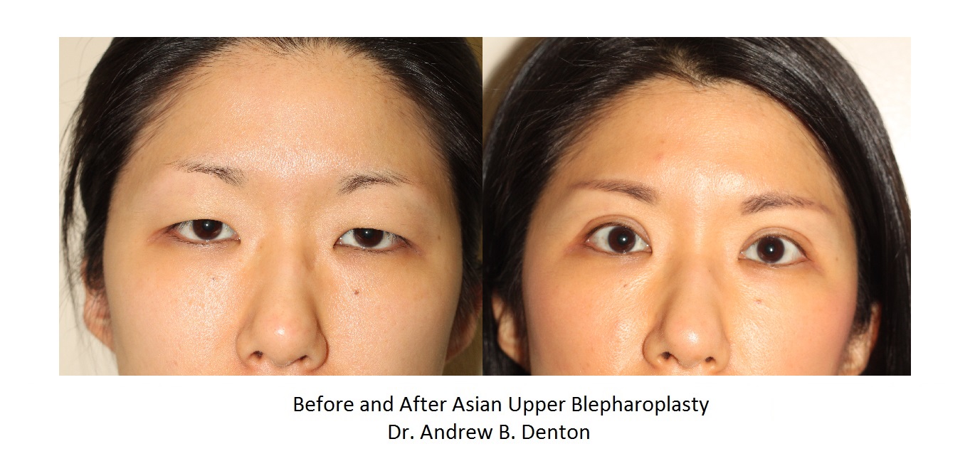 asian-blepharoplasty