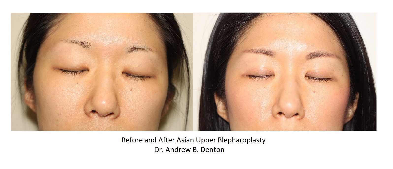 asian-blepharoplasty