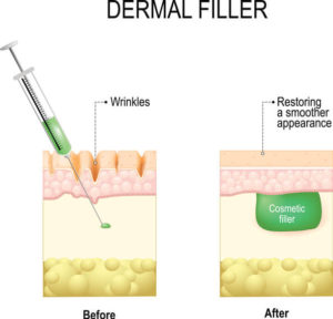 injectable_treatments_dermal_fillers