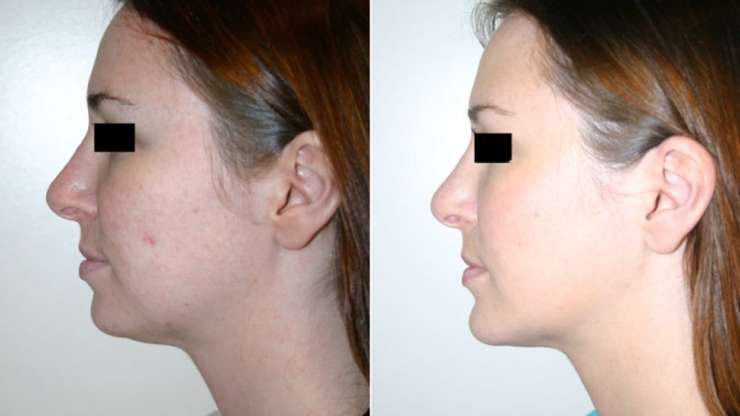 Facial Implants in Vancouver: A Permanent Solution for Facial Contouring and Balance