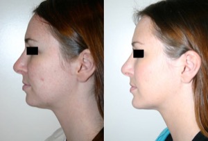 Dr. Denton chin implant before and after photo of a female patient