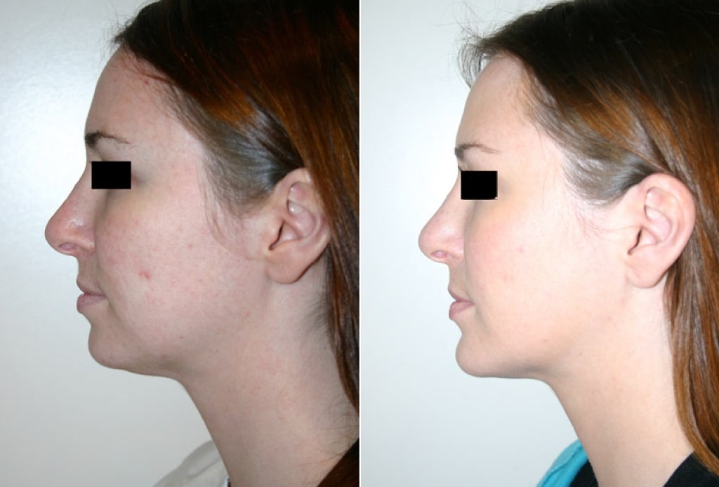 Dr. Denton chin implant before and after photo of a female patient