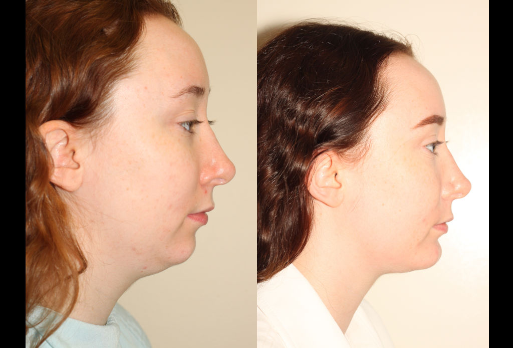 Before & After images of Facial liposuction of a young woman