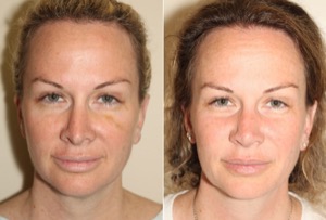 Dr. Denton Rhinoplasty before and after photo of a female patient