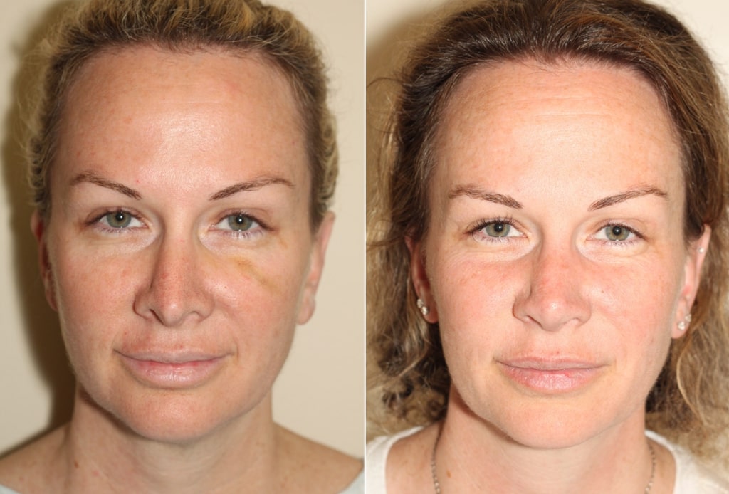 Dr. Denton Rhinoplasty before and after photo of a female patient