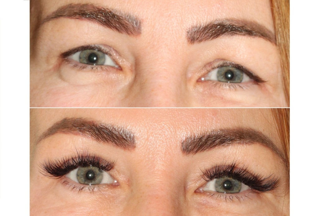 Dr. Denton blepharoplasty before and after photo of a female patient