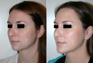 Dr. Denton chin implant before and after photo of a female patient