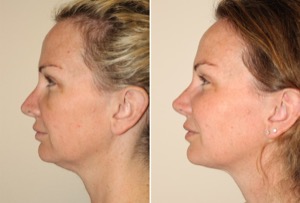 Dr. Denton Rhinoplasty before and after photo of a female patient