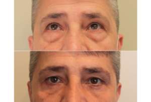 Dr. Denton blepharoplasty before and after photo of a male patient