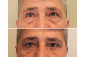 Dr. Denton blepharoplasty before and after photo of a male patient