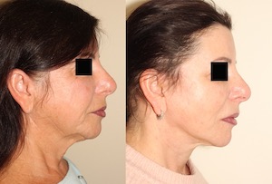 Dr. Denton facelift before and after photo of a female patient