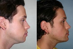 Dr. Denton chin implant before and after photo of a male patient